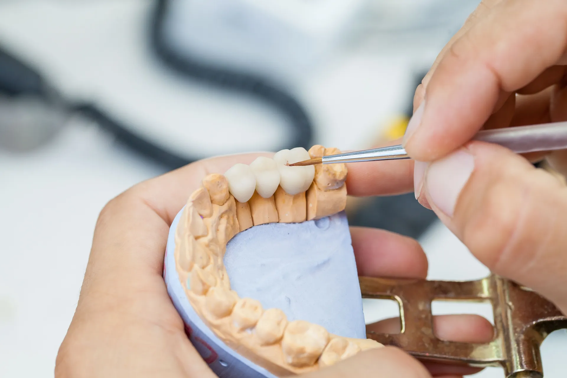 Dental Bridges in Dallas, TX - R. David Brumbaugh, DDS