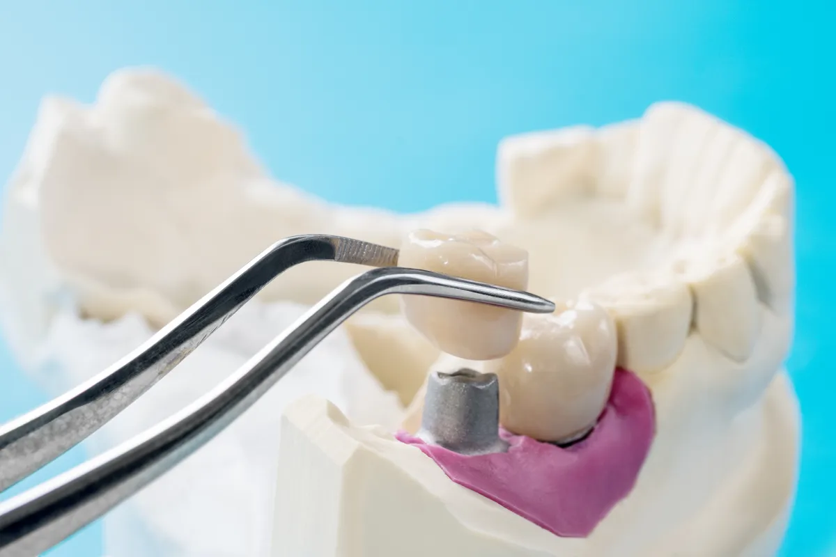 Restorative Dentistry in Dallas, TX - R. David Brumbaugh, DDS