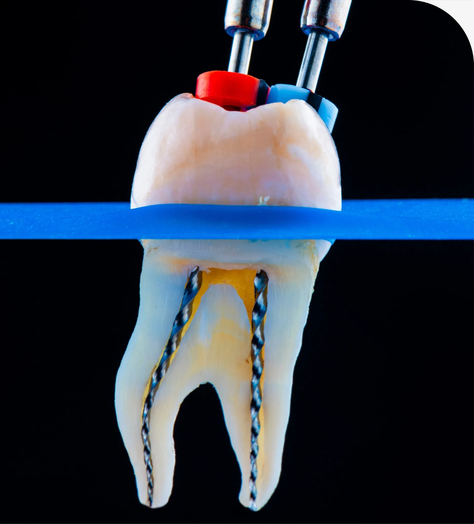 Root Canal Therapy in Dallas, TX - R. David Brumbaugh, DDS