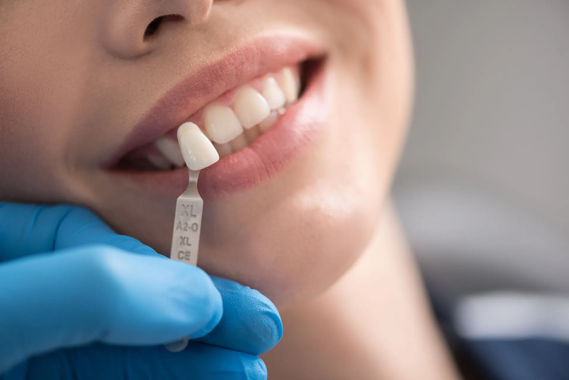 Same-Day Crowns in Dallas, TX - R. David Brumbaugh, DDS